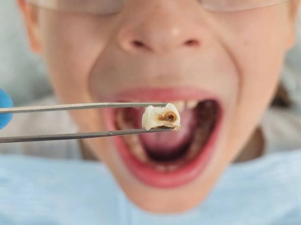 Best Emergency Dental Care for Broken or Chipped Teeth in Sumner, WA
